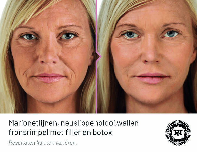 Voor-Na marionetlijnen, neuslippenplooi, fronsrimpel en wallen met filler en botox