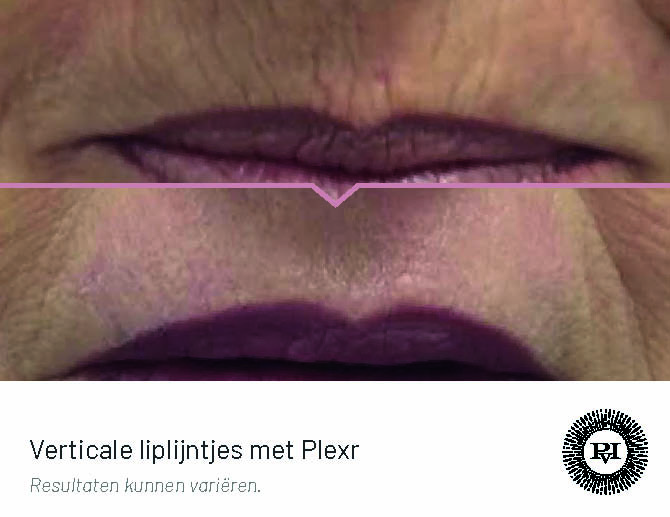 Verticale Liplijntjes