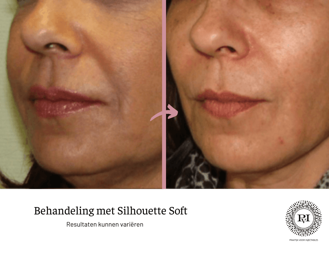 Silhouette soft voor- en nafoto