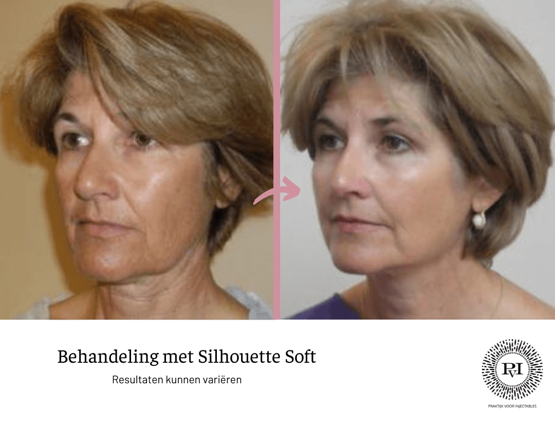 Silhouette soft voor- en nafoto
