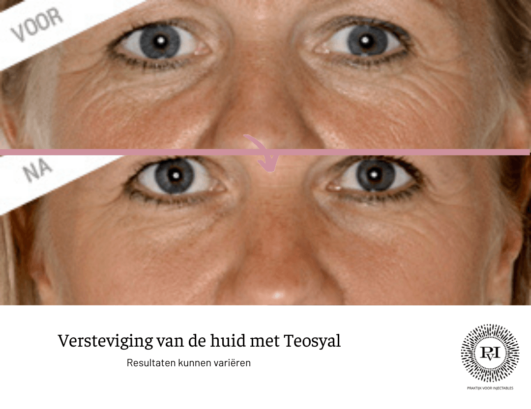 Teosyal voor- en nafoto