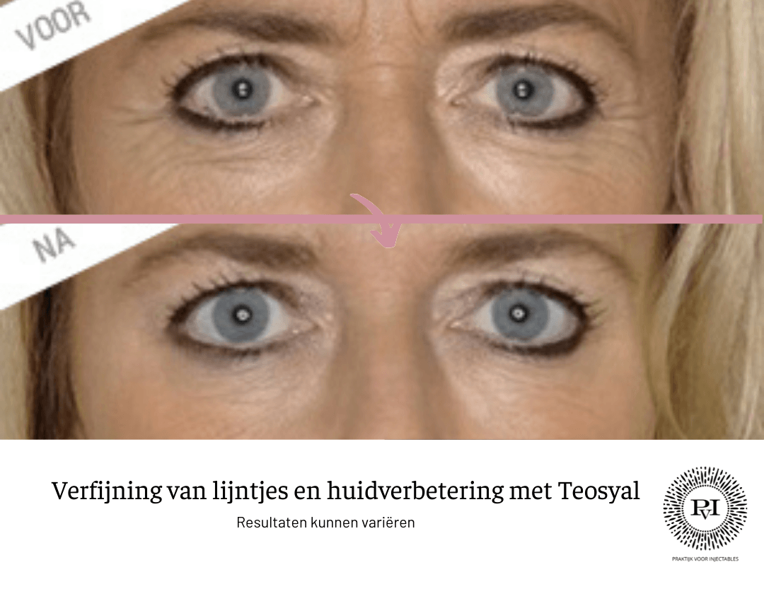 Teosyal voor- en nafoto