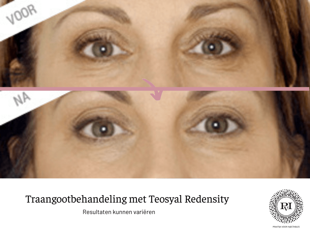 Teosyal voor- en nafoto