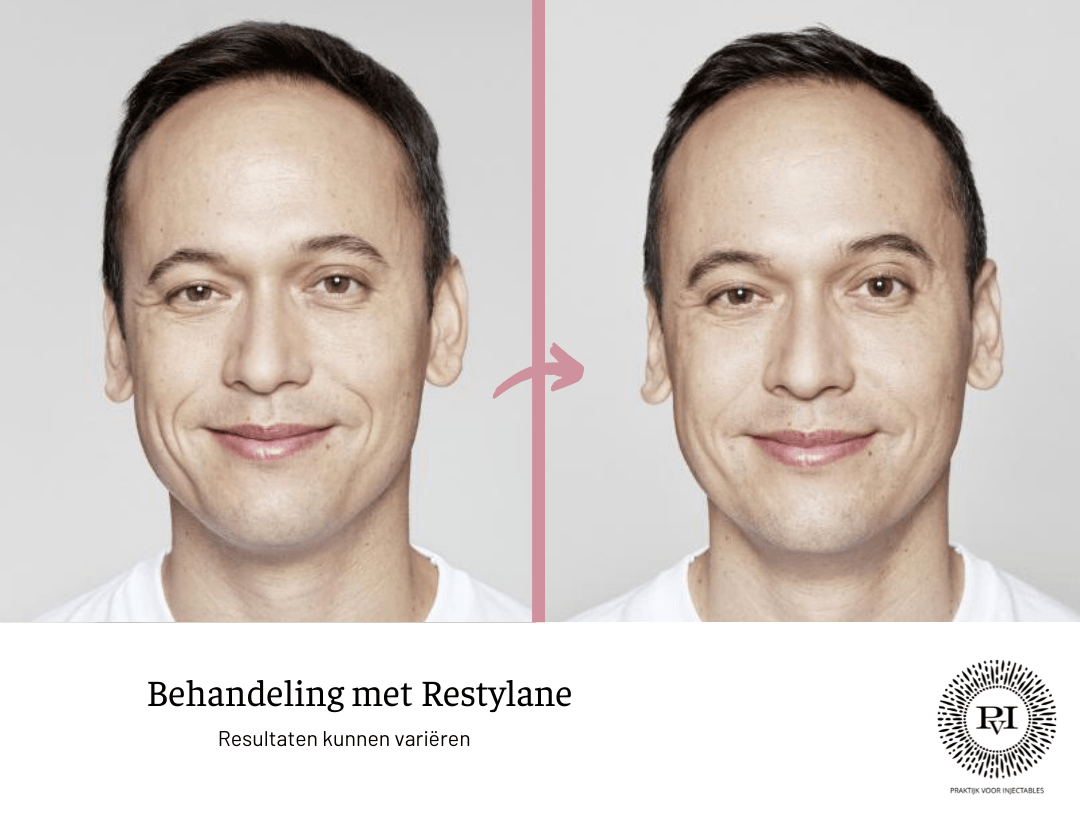 Restylane voor- en nafoto