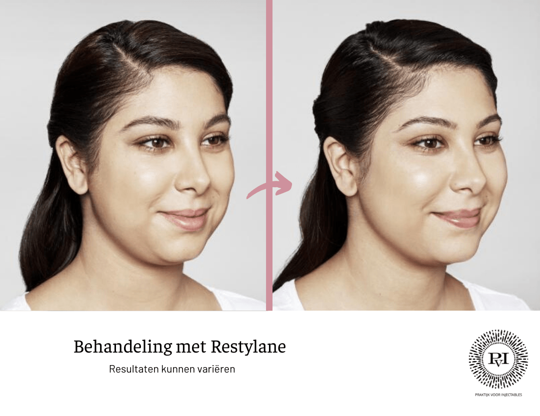 Restylane voor- en nafoto