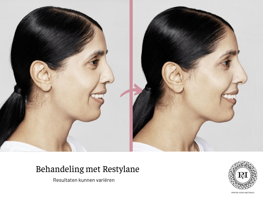 Restylane voor- en nafoto
