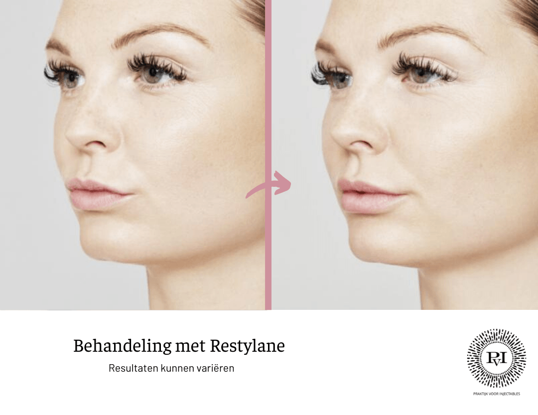 Restylane voor- en nafoto
