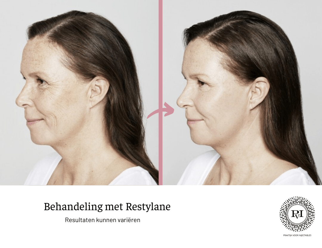 Restylane voor- en nafoto