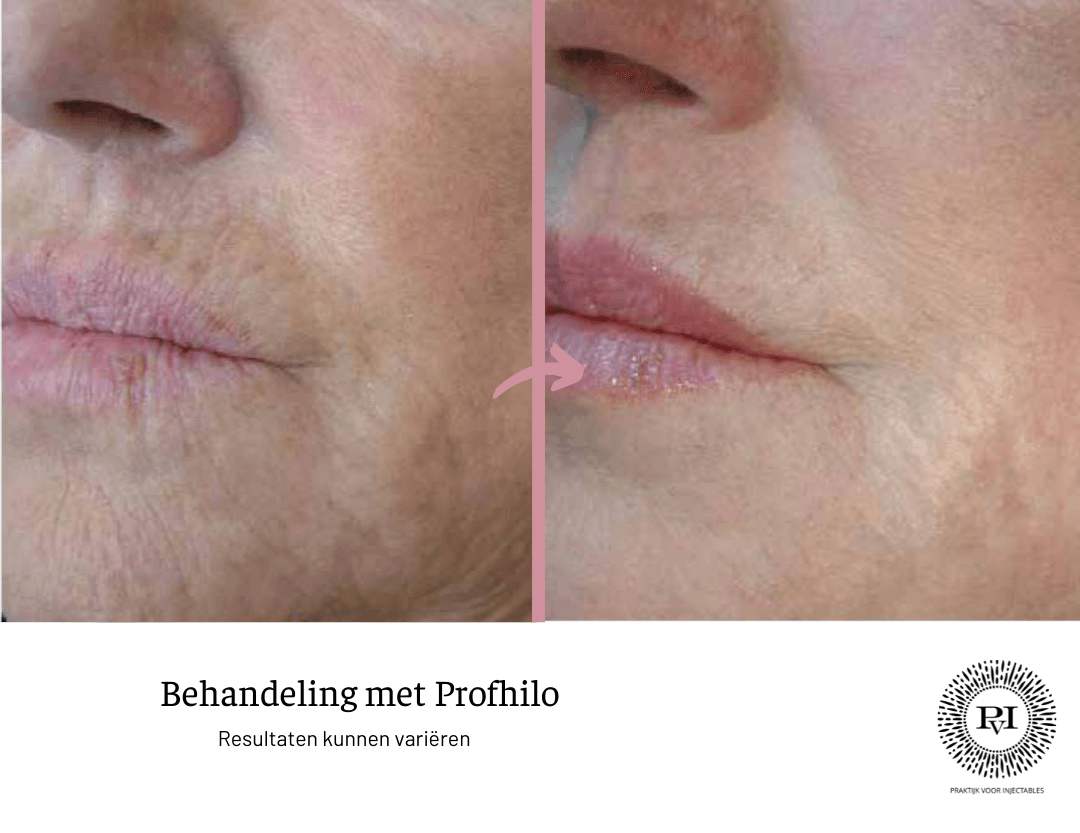 Profhilo voor- en nafoto