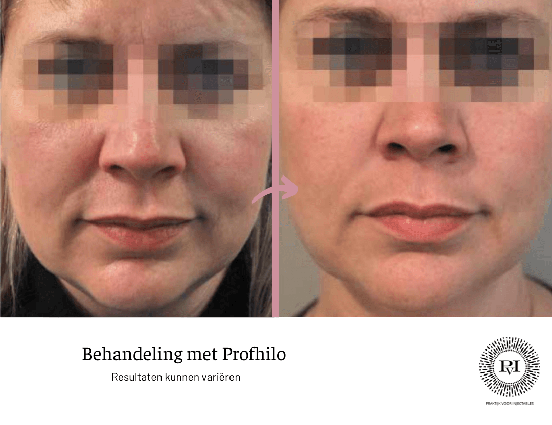 Profhilo voor- en nafoto