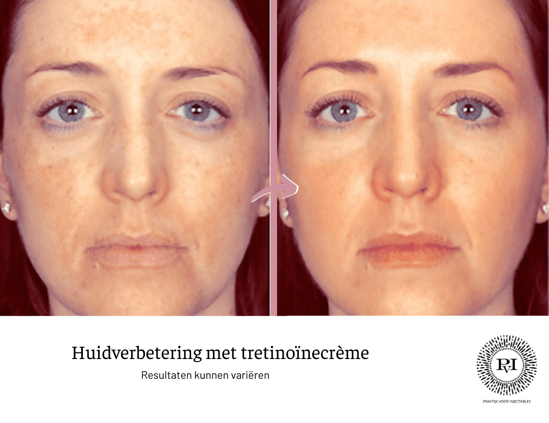 Voor en na foto tretinoine creme