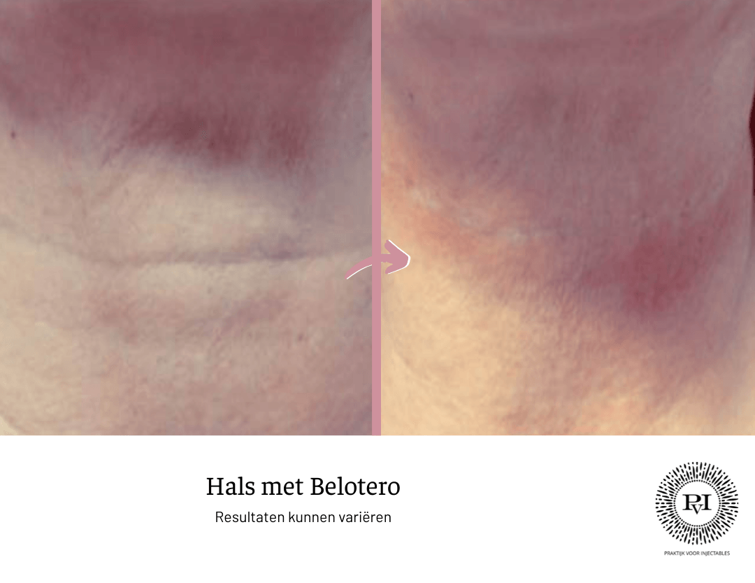 Voor en na foto belotero hals