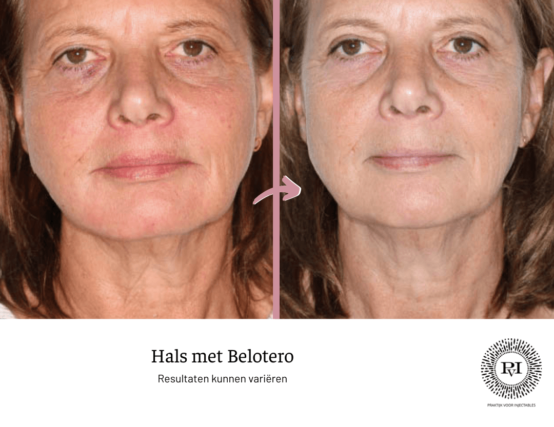 Voor en na foto belotero hals