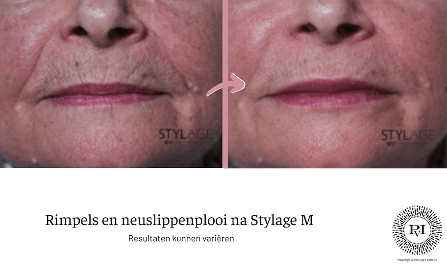 Voor en na foto Stylage M
