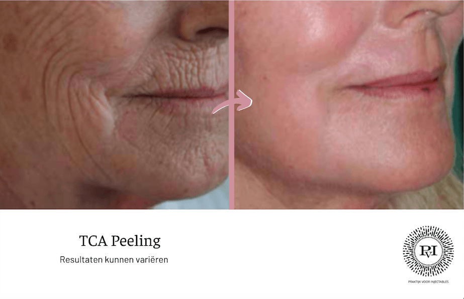 Voor en na foto tca peeling
