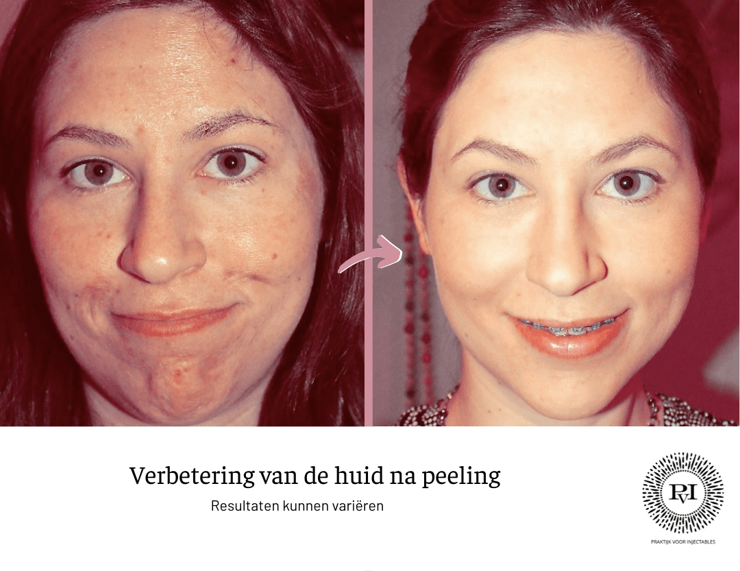 Voor en na foto peeling