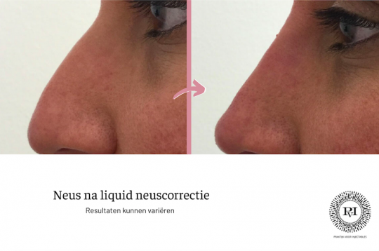 Voor en na neus liquid neuscorrectie