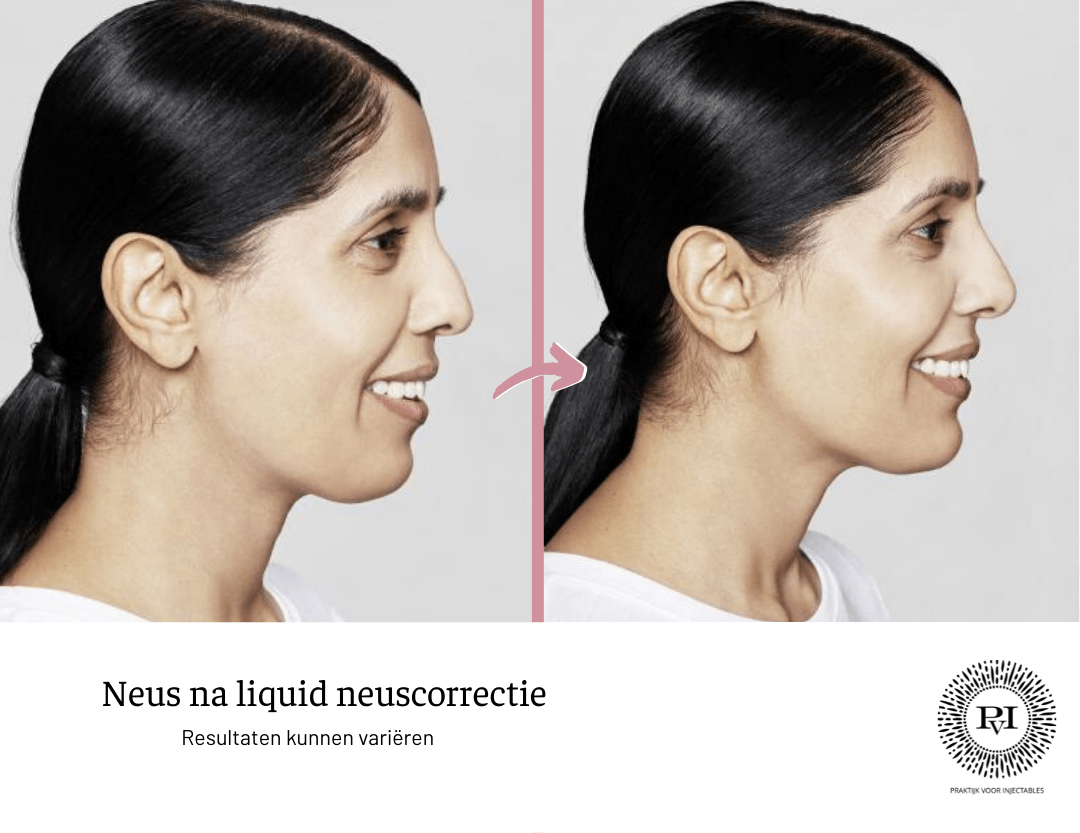 Voor en na foto neus na Restylane