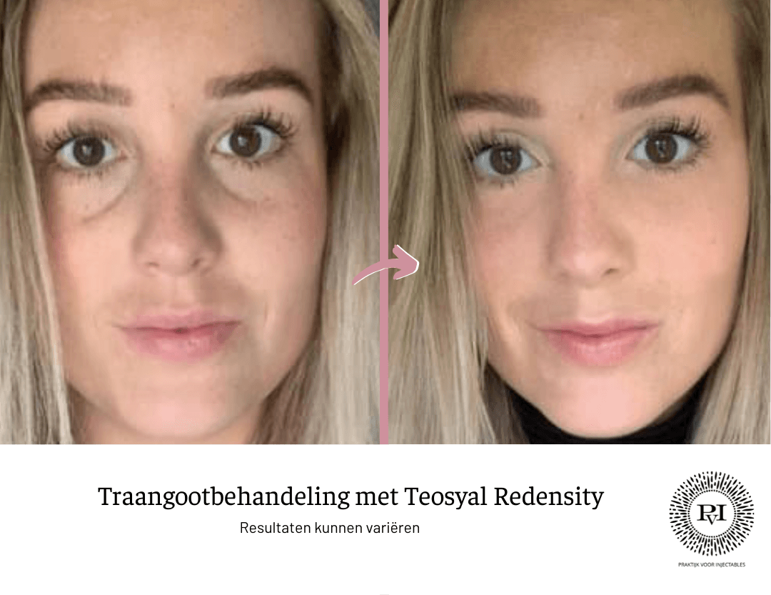traangoot voor na teosyal redensity