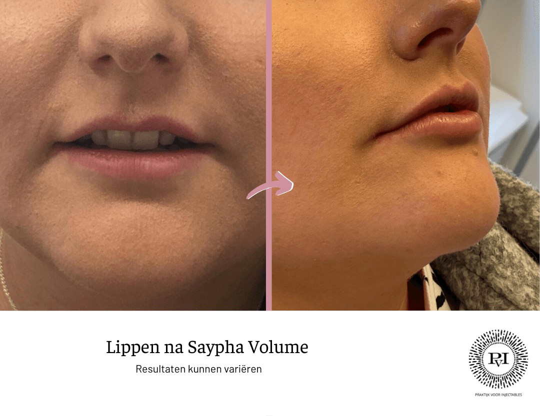 lippen voor na saypha volume