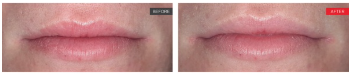 Vollere lippen zonder injecties
