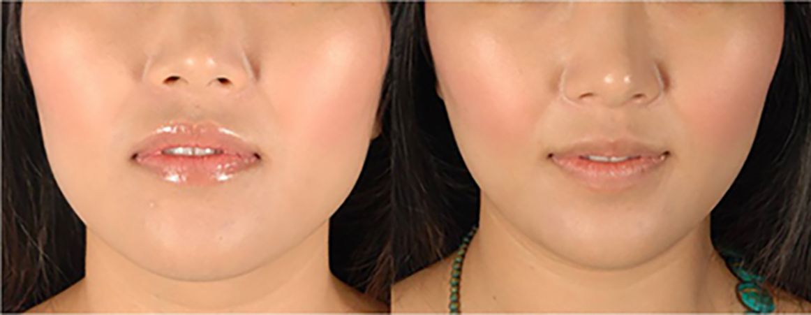 Face slimming