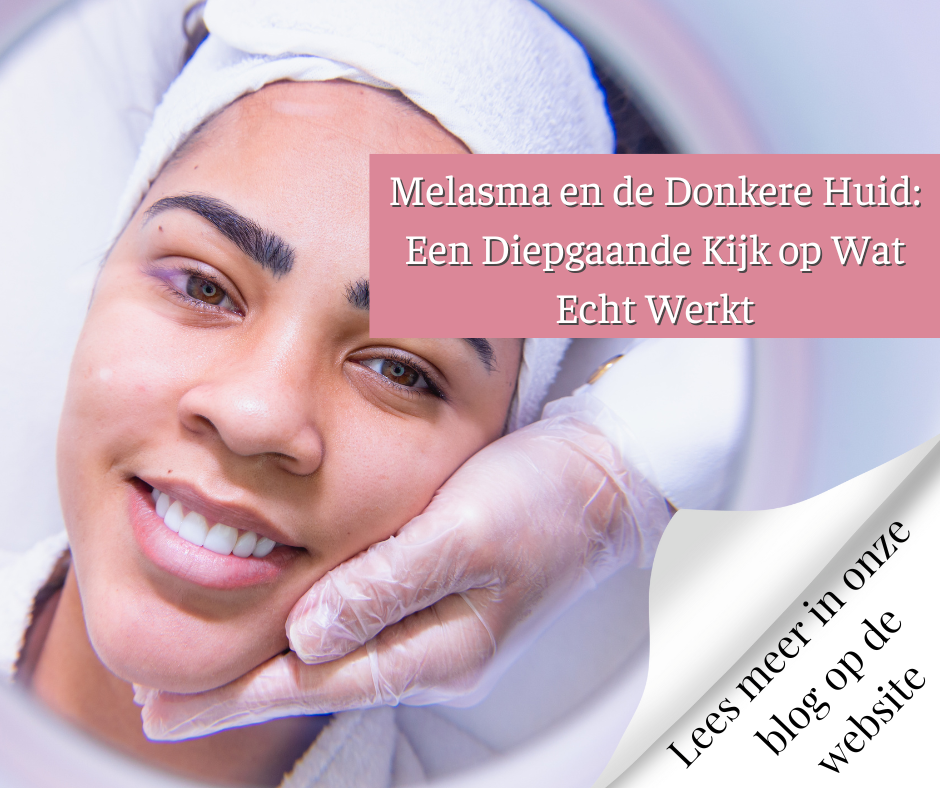 Melasma en de Donkere Huid Een Diepgaande Kijk op Wat Echt Werkt